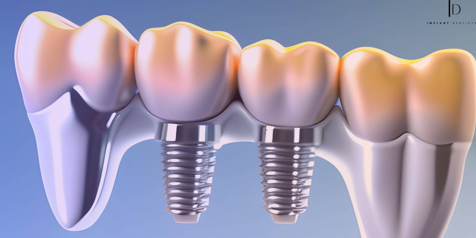 Are Dental Implants Best for You? Factors to Consider Before Making a Decision