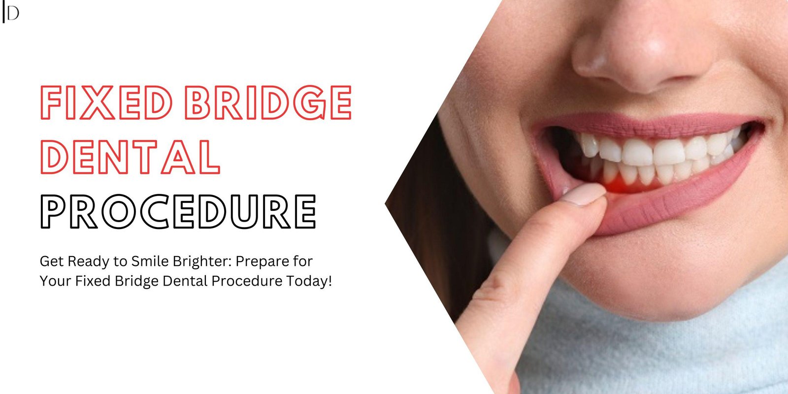 How to Prepare for a Fixed Bridge Dental Procedure