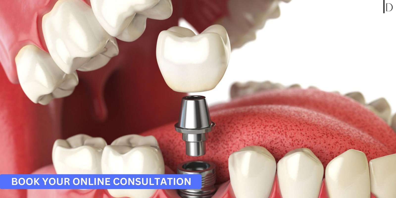 The Implant Dentists: Your Premier Destination for Dental Implants