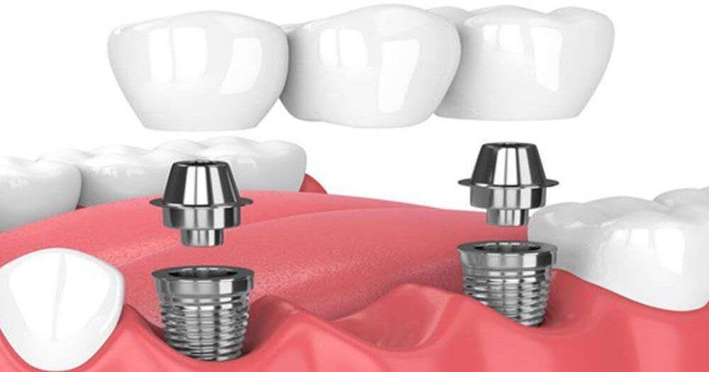 The Implant Dentists: Your One-Stop Shop for Dental Implants