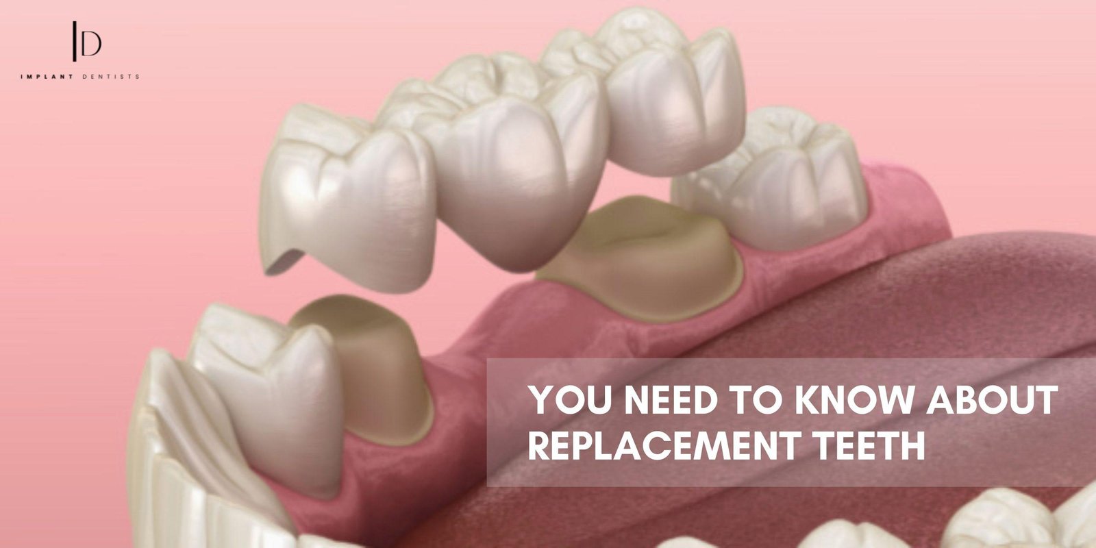 Restoring Your Smile | Everything You Need to Know About Replacement Teeth