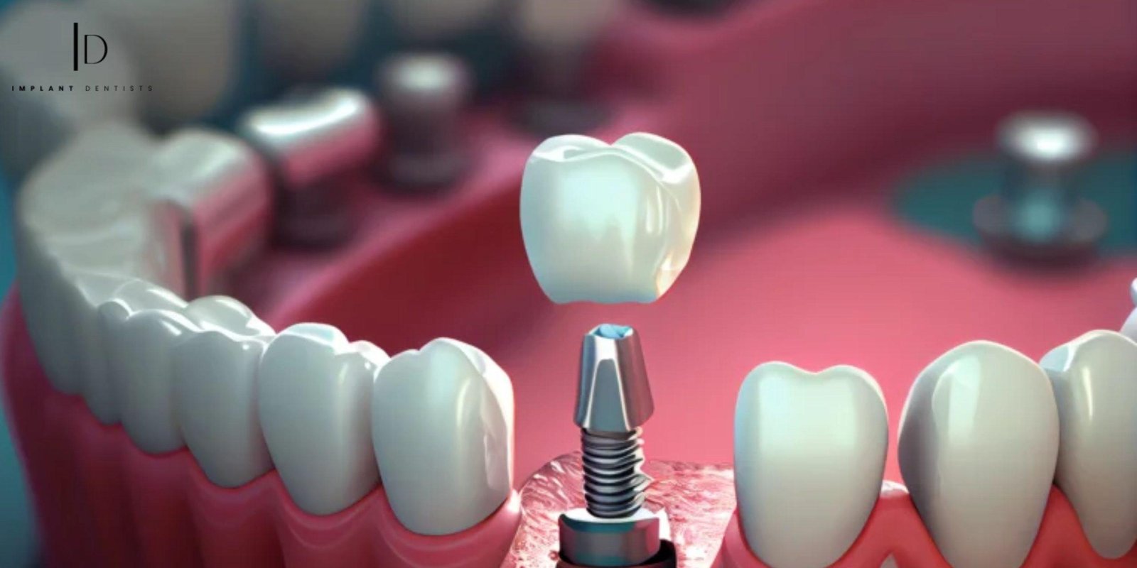 Bridge to Confidence | Exploring Bridge Tooth Implants and Replacement Teeth