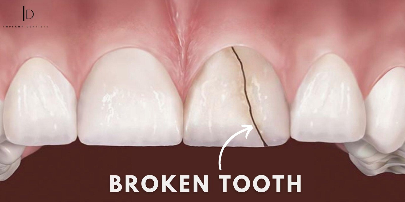 Saving Smiles| Exploring 5 Causes, Treatments & Benefits for Broken Tooth