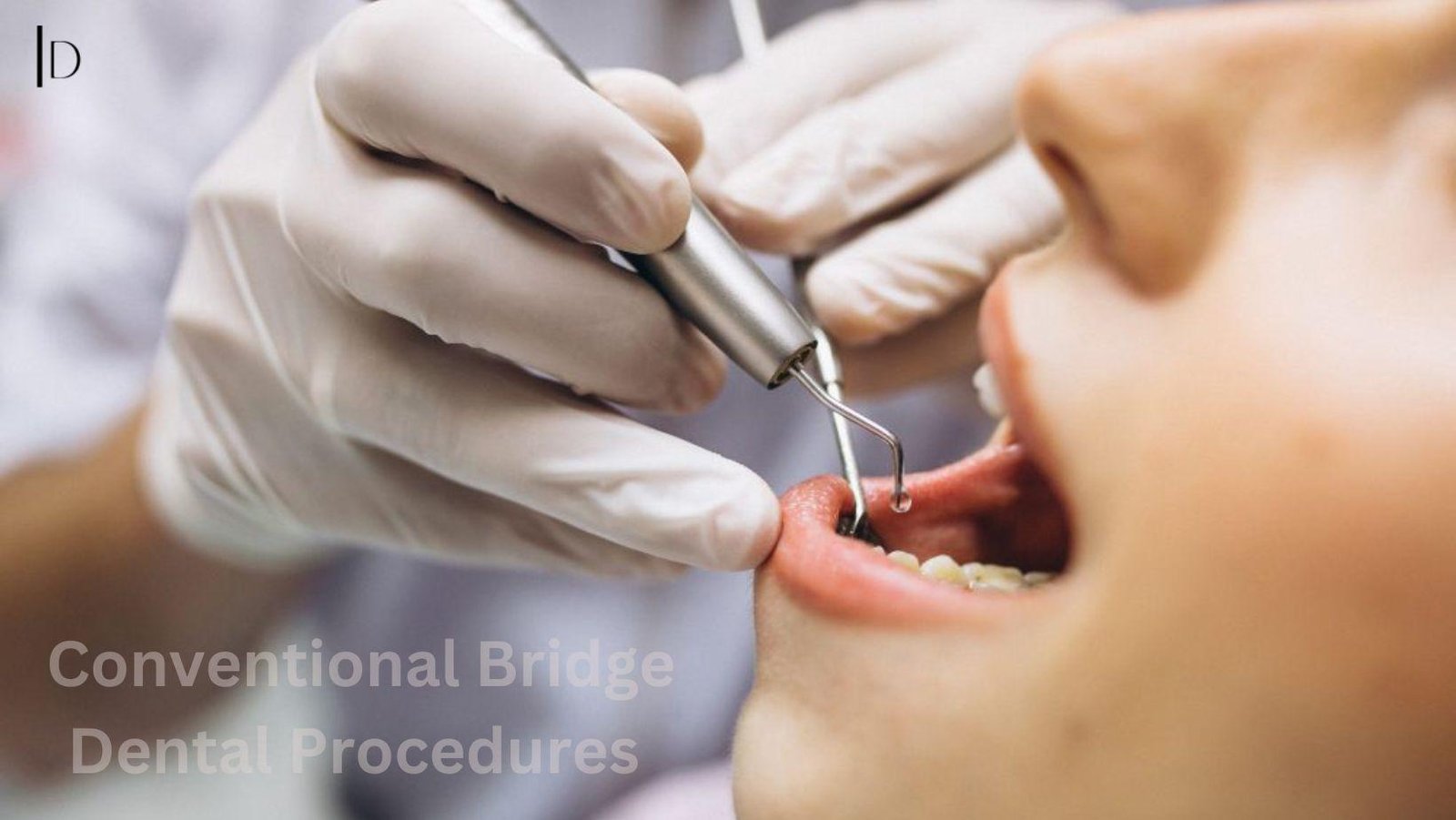 Benefits and Considerations of Conventional Bridge Dental Procedures