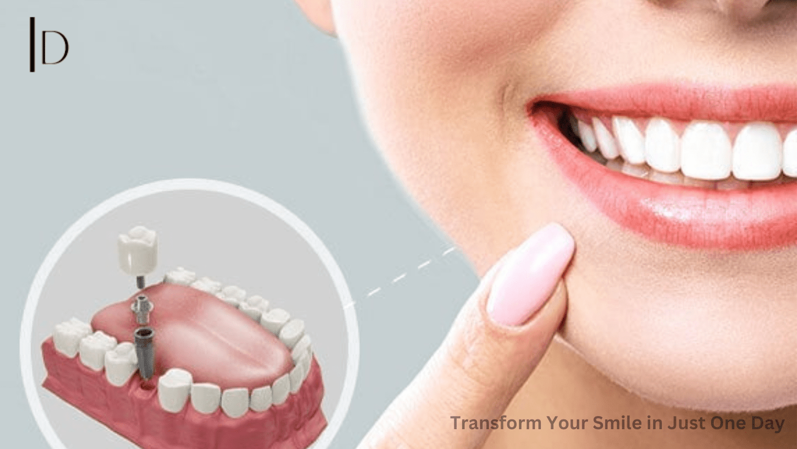 Transform Your Smile in Just One Day: The Magic of Teeth in a Day