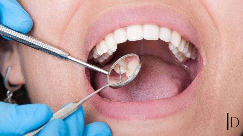 Understanding Teeth Lose Causes, Prevention, and Treatment